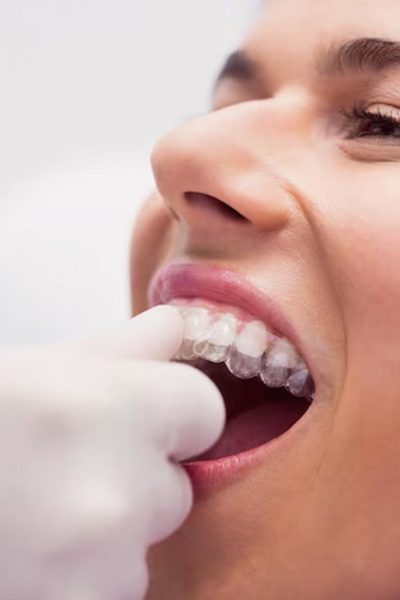 Invisalign Bridge Cosmetic