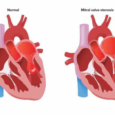 How Is COVID-19 Affecting Mitral Stenosis Patients?